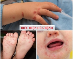 HÃY CHỦ ĐỘNG PHÒNG BỆNH TAY CHÂN MIỆNG